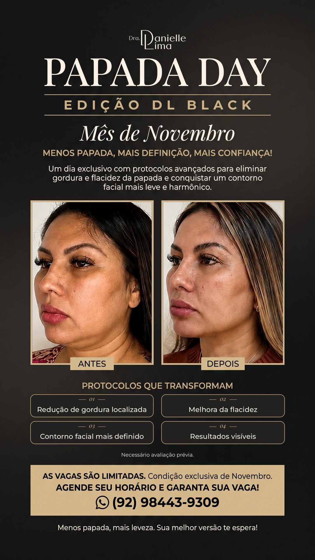 Flyer oficial Papada Day, Edição DL Black de novembro, com caso real antes e depois